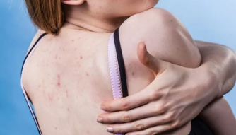 Why are there pimples on your back and how to fight them