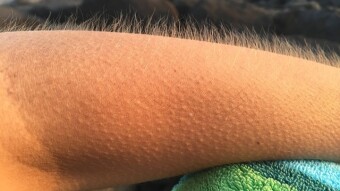 Why do we get Goosebumps?