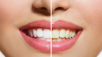Eliminate the yellow looks of teeth with a banana peel!