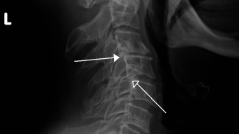 Ruta >> An Ultimate Cure from Cervical Spondylosis >>> Homeopathy