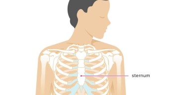 Living with a Cracked Sternum Experience