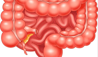 Crohn’s Disease and its Complications