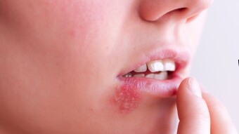 Herpes, is that dangerous?