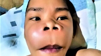 I Am Worried About My Mother's Tonsillitis