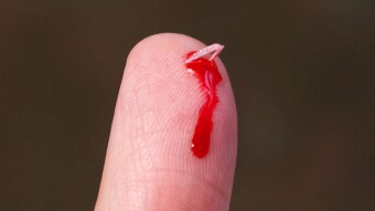 Remove Splinters with Homeopathy >>> Must Read