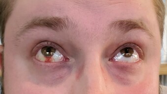 Today I Randomly Blew A Blood Vessel