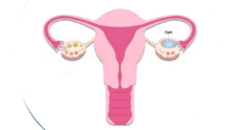 Ovarian Cyst