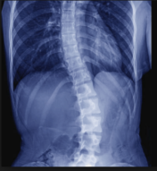 Back Pain