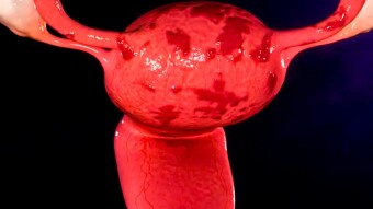 Endometriosis