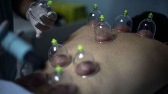 What is Hijama and What are the Health Benefits?