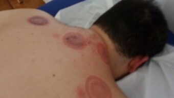 accupuncture Time