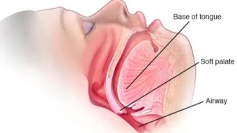 How to stop Snoring?