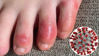 The mystery behind the “Covid Toes”