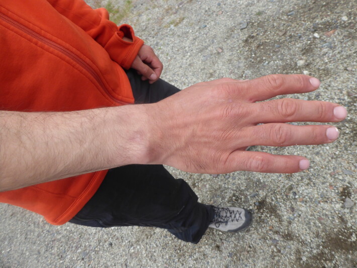 My hand after the trip
