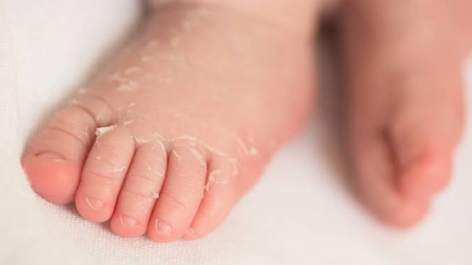 baby suffering from scalded skin syndrome