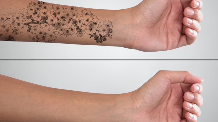 Tattoo Removal Treatments How Long Do You Need To Wait Between Sessions